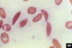 This microscope photo provided by the Centers for Disease Control and Prevention shows crescent-shaped red blood cells from a sickle cell disease patient in 1972. (Dr. F. Gilbert/CDC via AP)