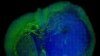 Polio Virus Used to Kill Brain Tumors