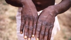 Sango ya Mokili Lelo: Moto moko akufi na Monkeypox na Sud-Ubangi