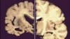 Science in the News: Phone App to Assist Alzheimer’s Caregivers