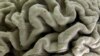 Study: Gene May Cause Alzheimer’s in Some Cases