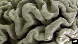 FILE - A section of a human brain with Alzheimer's disease is displayed at the Museum of Neuroanatomy at the University at Buffalo, in Buffalo, N.Y., Oct. 7, 2003. (AP Photo/David Duprey, File)