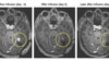 New Way to Fight Brain Cancer Shows Promise