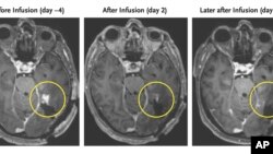 This combination of MRI scan images provided by the New England Journal of Medicine in March 2024 shows the progress of a glioblastoma patient who received CAR-T therapy which uses modified versions of T cells from a patient's own immune system. (NEJM via AP)