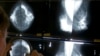 Reducción histórica en mortalidad por cáncer en EEUU pero preocupa aumento en mujeres y jóvenes