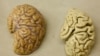Researchers: Viruses May Help Cause Alzheimer’s Disease