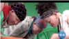 Women with Albinism Struggle for Acceptance